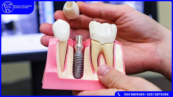 Ưu điểm của trồng răng Implant