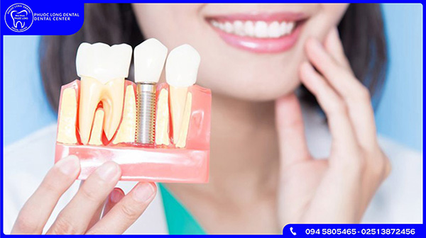 Quy trình chăm sóc, vệ sinh răng miệng sau cấy ghép Implant